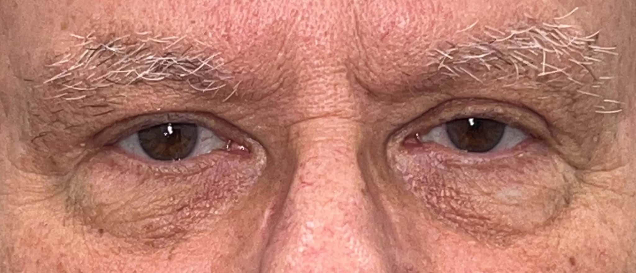 Brow lift and upper blepharoplasty 02 1