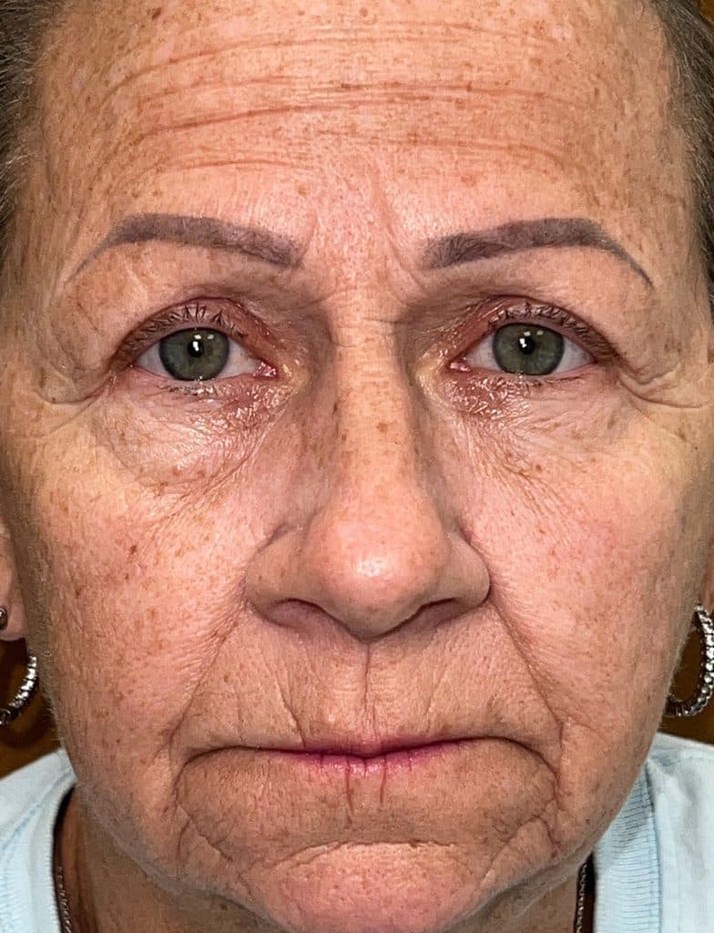 Ptosis repair and upper blepharoplasty 03