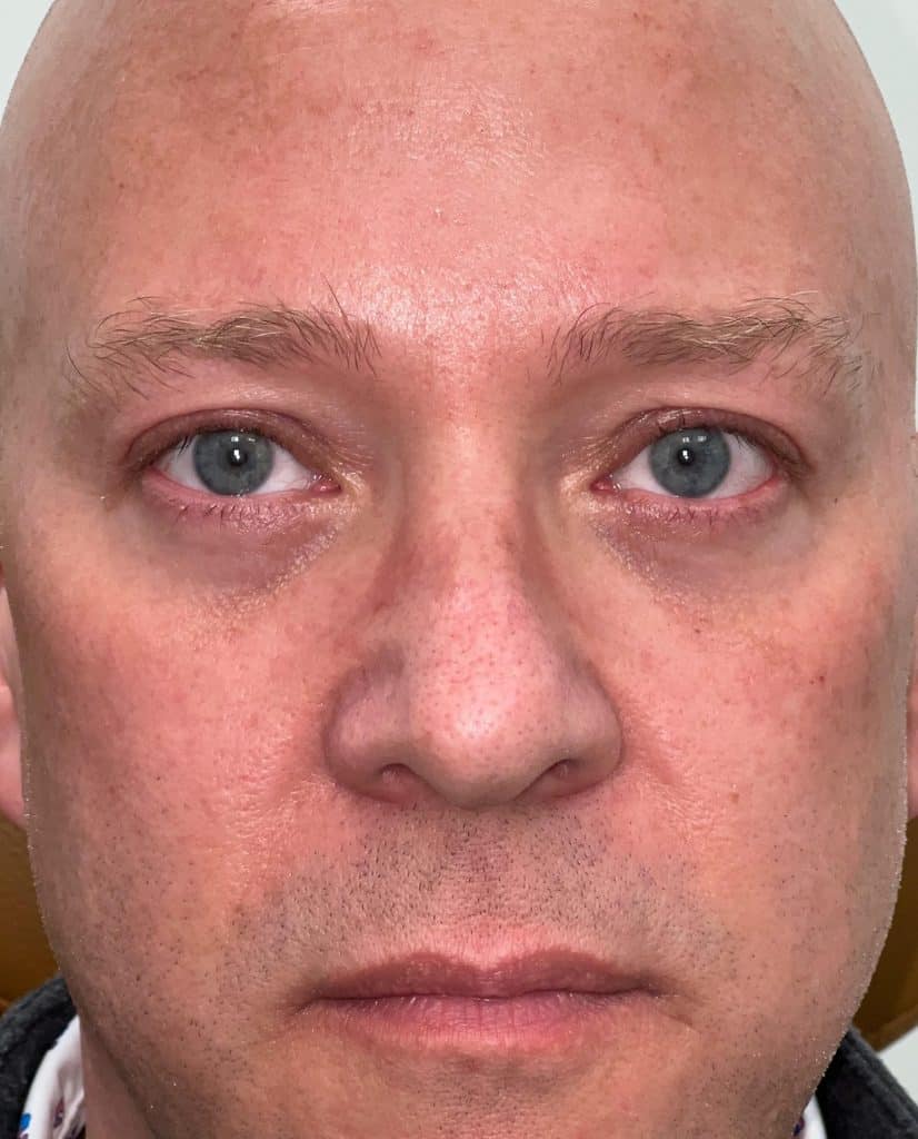 Ptosis repair upper and lower blepharoplasty 03