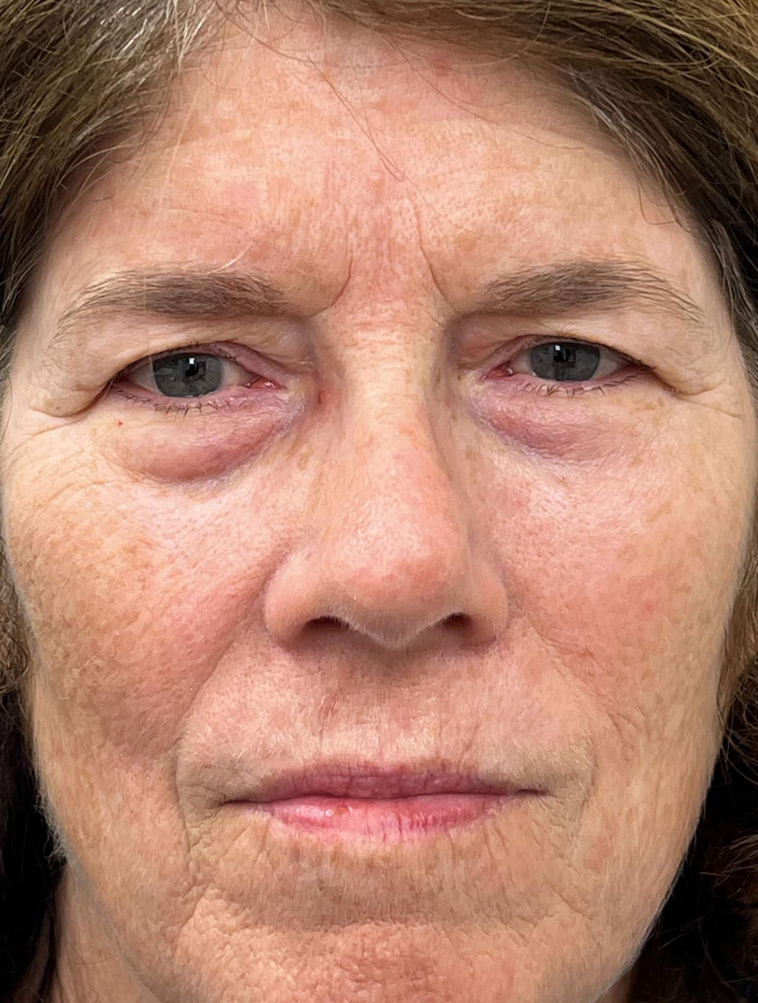 Upper and lower blepharoplasty and full face CO2 laser resurfacing 01