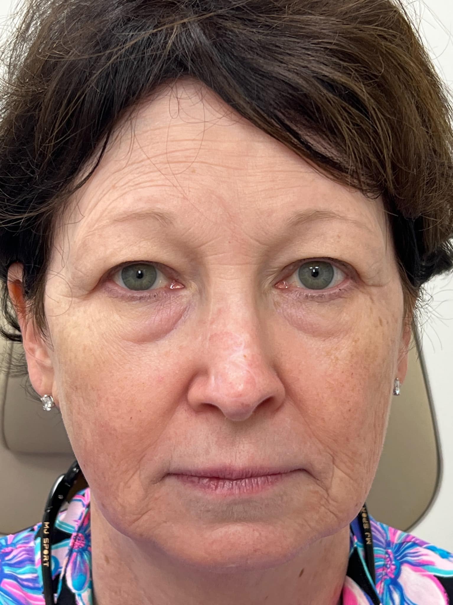 Upper and lower blepharoplasty brow life CO2 laser 01