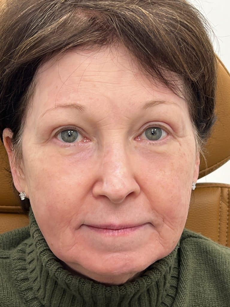 Upper and lower blepharoplasty brow life CO2 laser 03