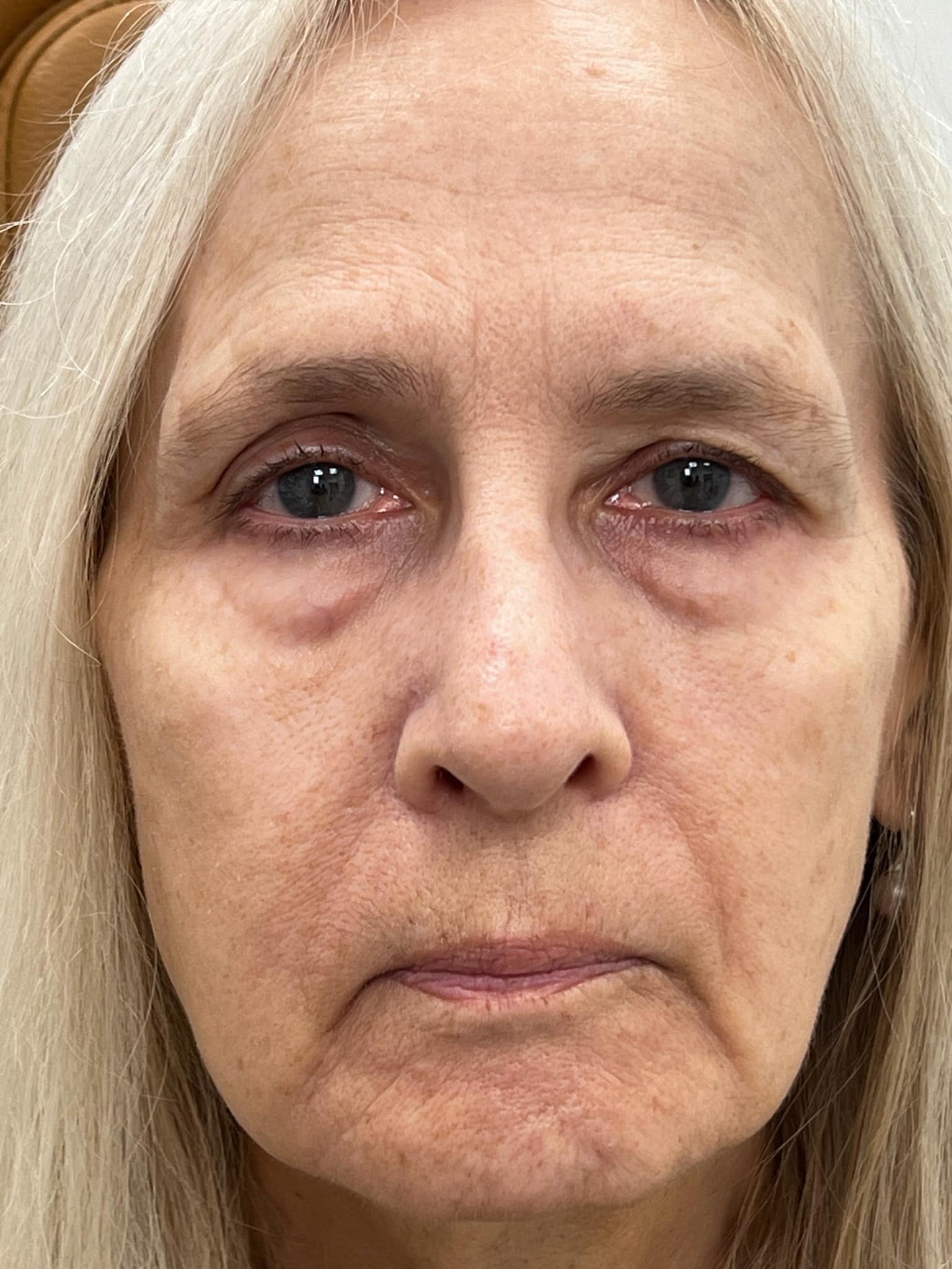 Upper and lower blepharoplasty brow lift CO2 laser resurfacing of the lower eyelids 01