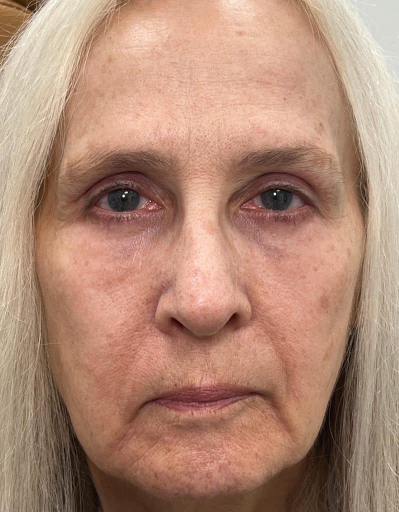 Upper and lower blepharoplasty brow lift CO2 laser resurfacing of the lower eyelids 03