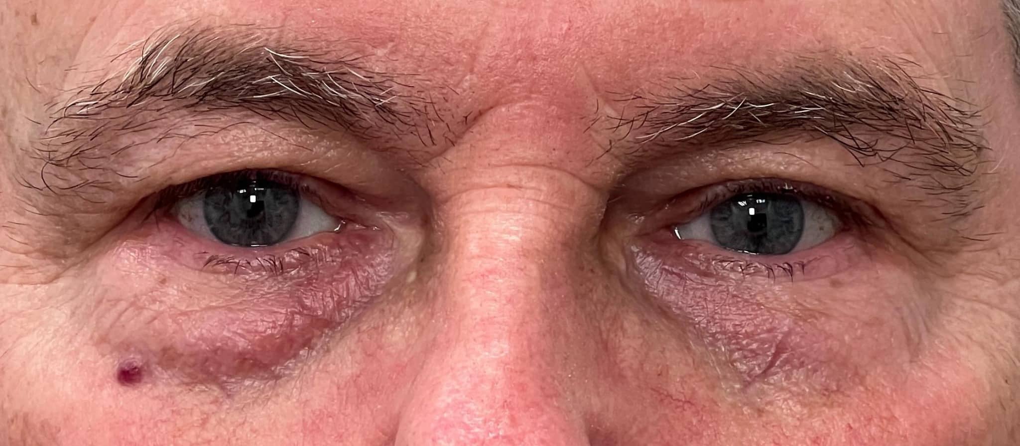 Upper and lower blepharoplasty copy 01