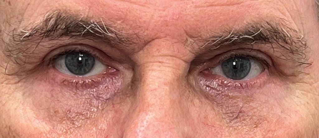 Upper and lower blepharoplasty copy 03