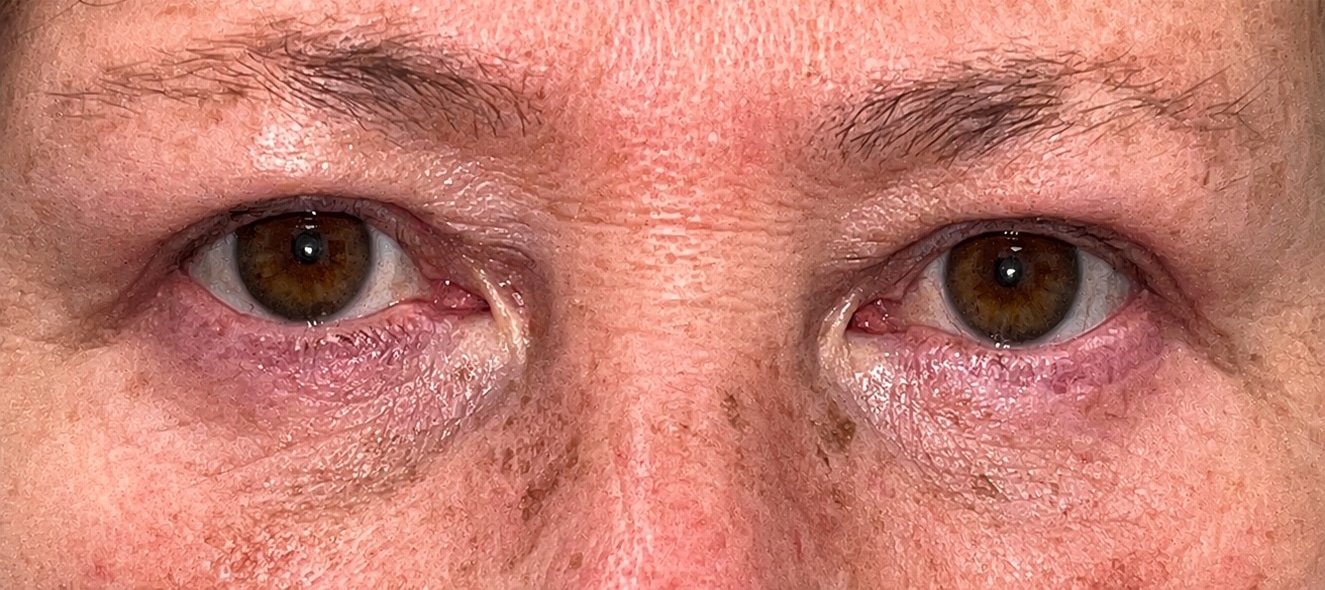 Upper and lower blepharoplasty with fat repositioning and a skin pinch technique 04