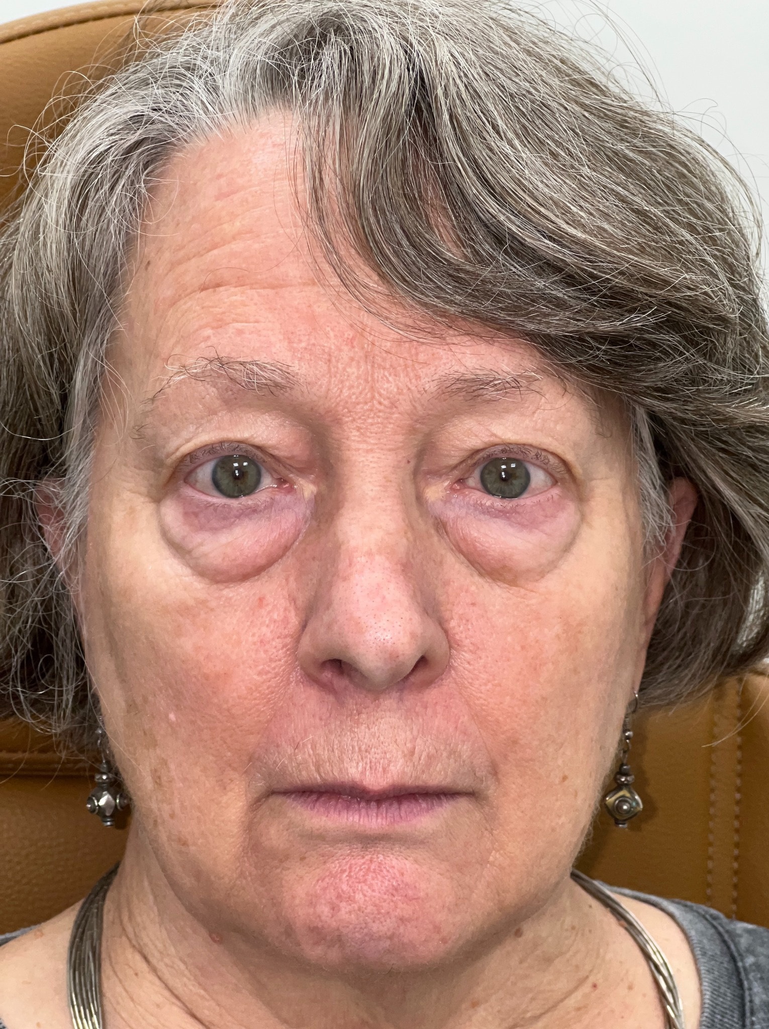 Upper and lower blepharoplasty 01
