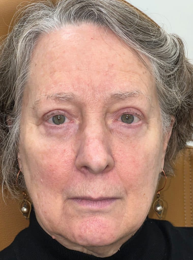 Upper and lower blepharoplasty 03