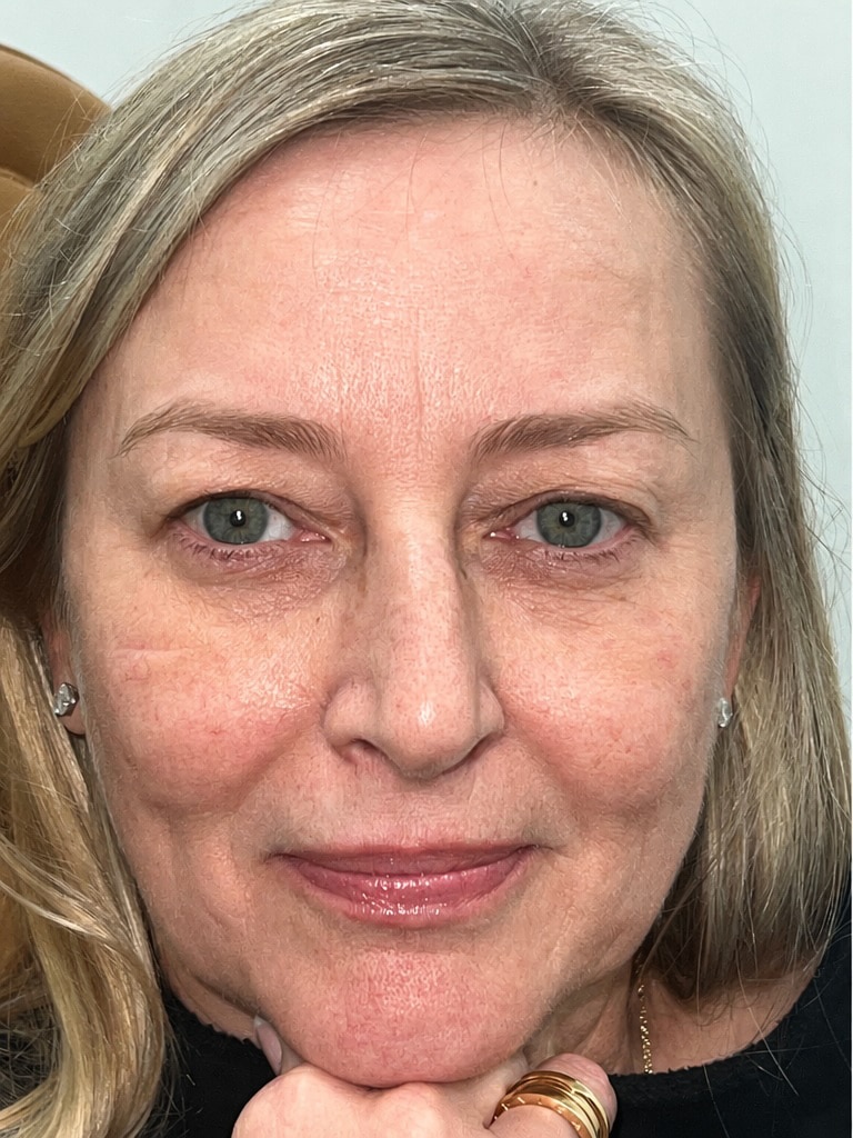 Upper blepharoplasty and full face CO2 laser resurfacing copy 01