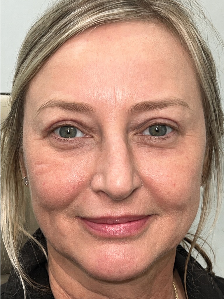 Upper blepharoplasty and full face CO2 laser resurfacing copy 02