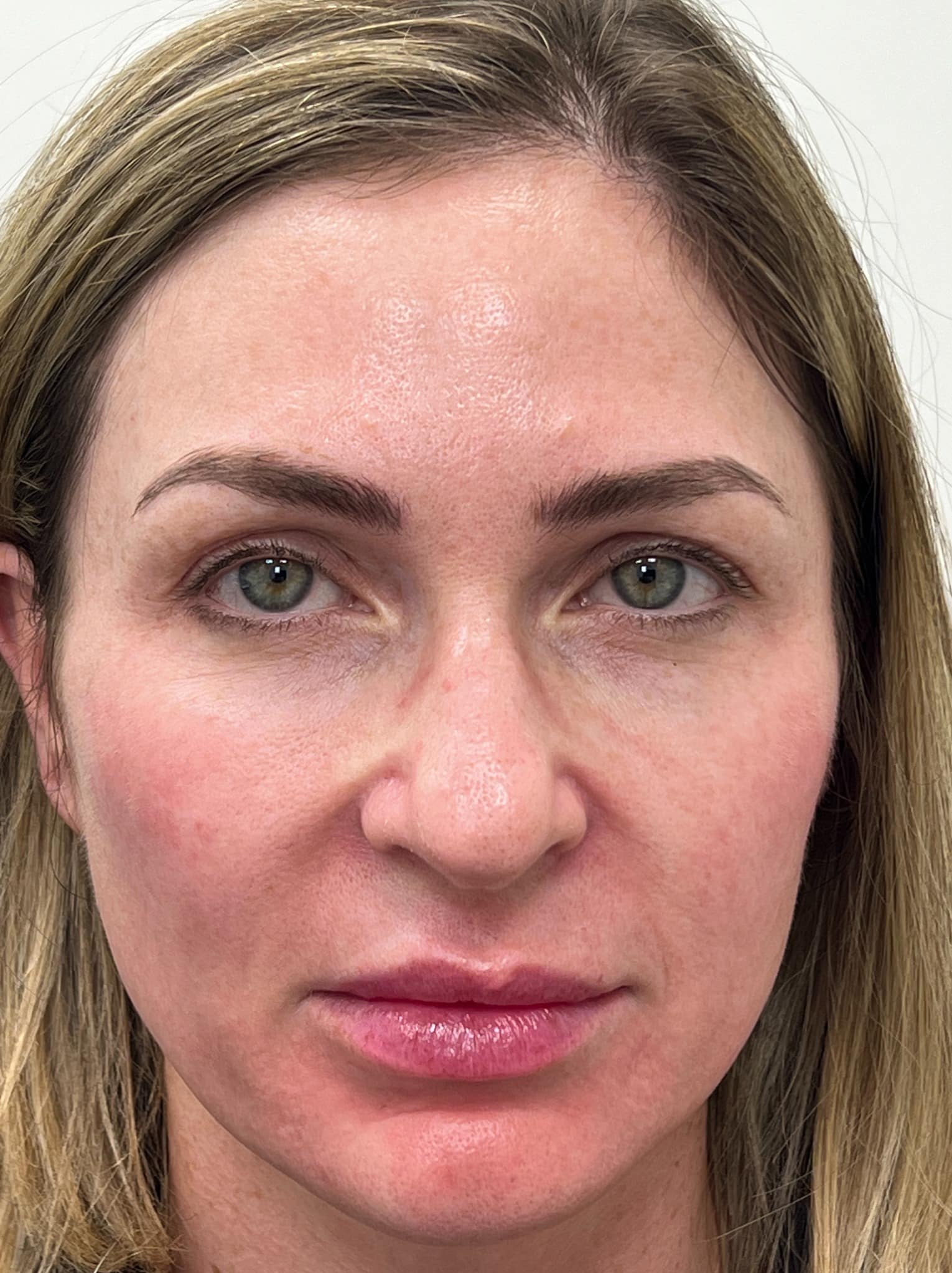 Upper blepharoplasty and full face CO2 laser resurfacing 01