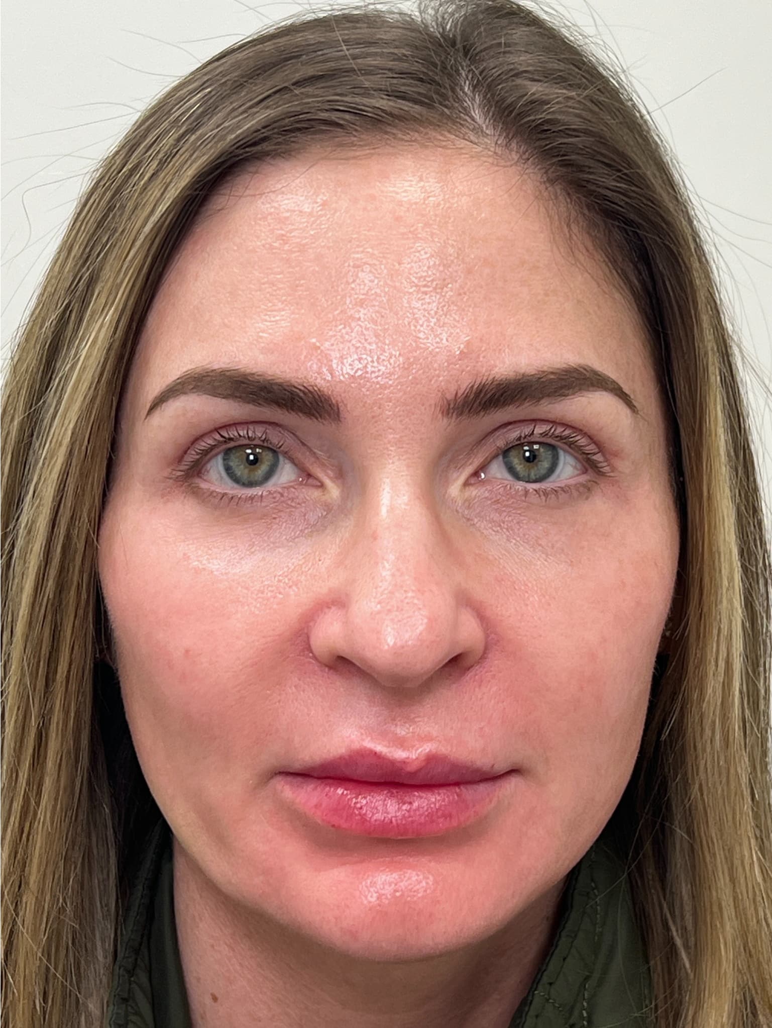 Upper blepharoplasty and full face CO2 laser resurfacing 03