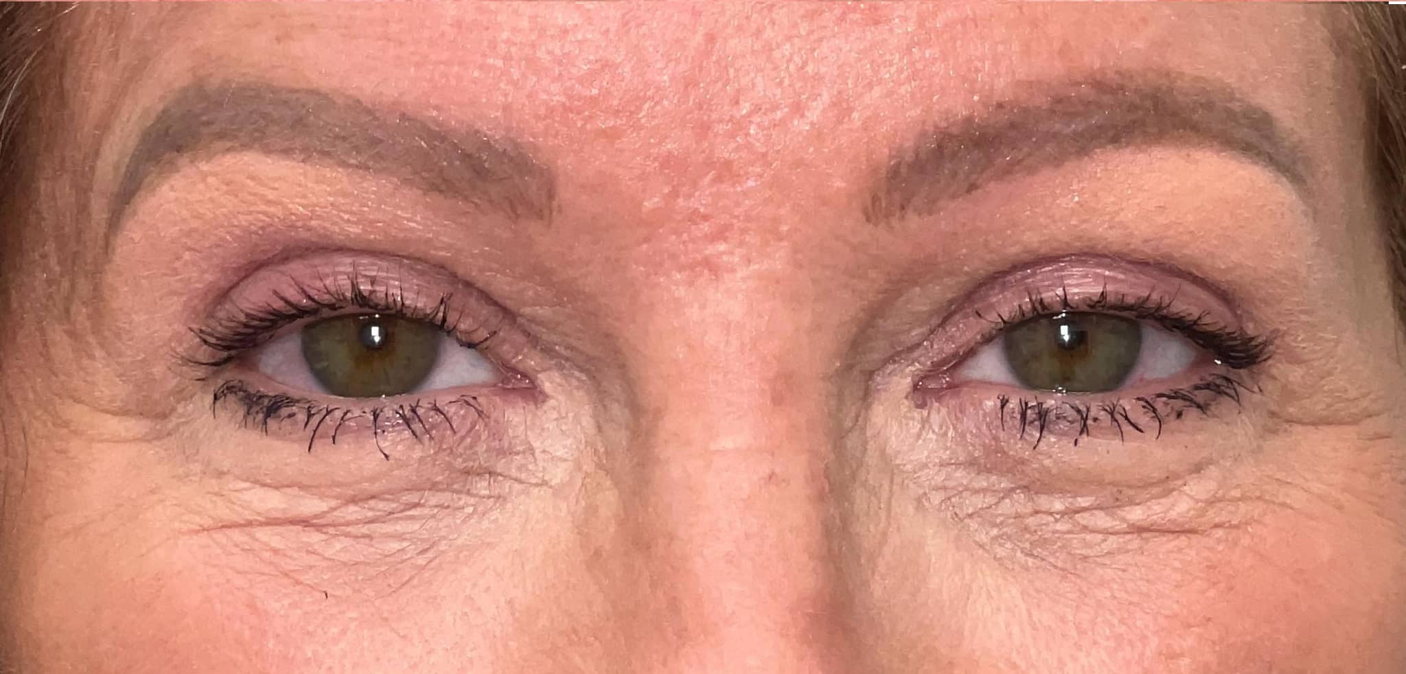 Upper blepharoplasty and internal