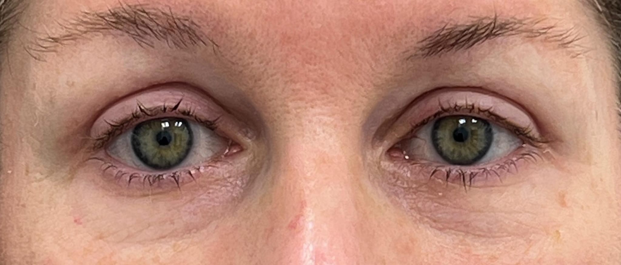 Upper blepharoplasty 03